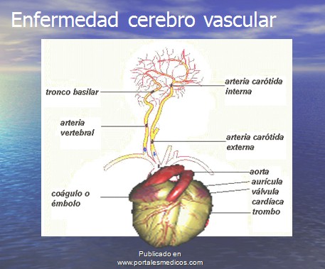 Arterias afectadas en un E.C.V